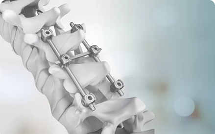 Izvedba i uporaba materijala od legura titana kao što su medicinske šipke od titana.